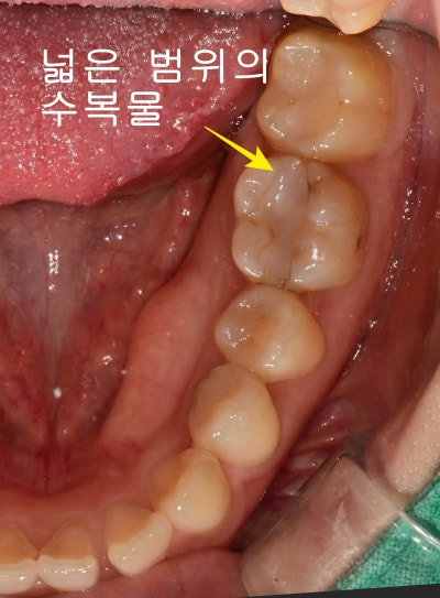 광희동 주변 치과 치아 크랙으로 인한 증상 신경치료 사진 5