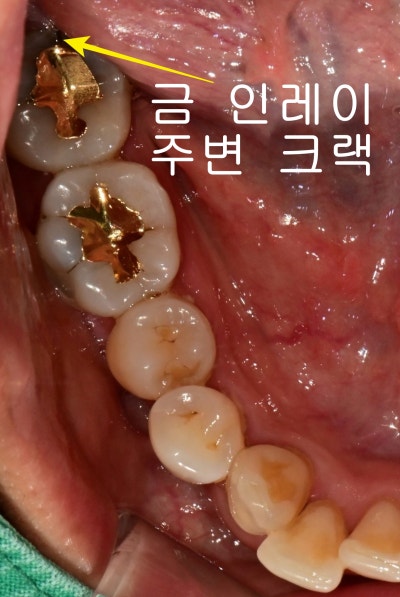 광희동 주변 치과 치아 크랙으로 인한 증상 신경치료 사진 2