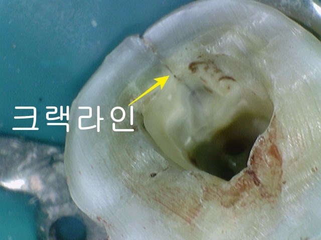 광희동 주변 치과 치아 크랙으로 인한 증상 신경치료 사진 3