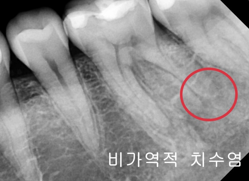 광희동 주변 치과 치아 크랙으로 인한 증상 신경치료 사진 4