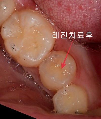 약수역치과 깊은 충치 신경치료 없이 치료하는 방법( MTA치료 ) 사진 7