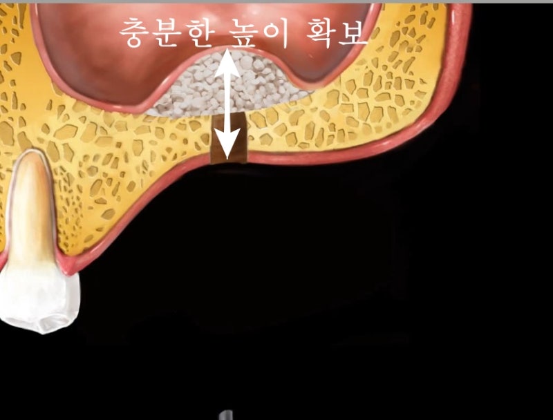 신당동 치과 오래전 빠진 치아 상태에서 임플란트 수술(상악동 거상술) 사진 4
