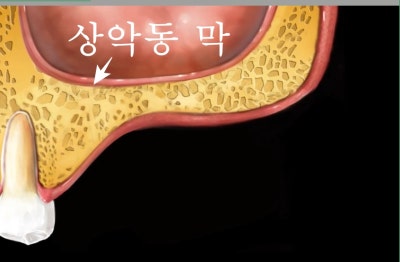신당동 치과 오래전 빠진 치아 상태에서 임플란트 수술(상악동 거상술) 사진 2
