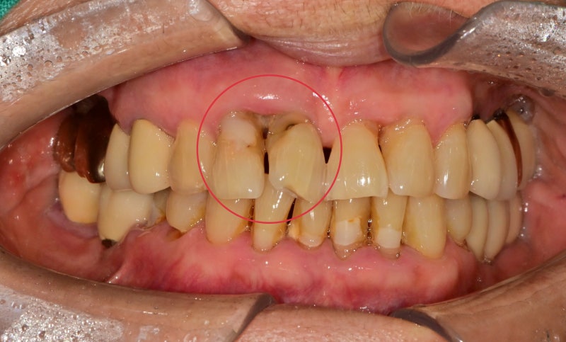 Yaksu-dong Dental Clinic: Treating Receding Gums Without Tooth Reduction 사진 2