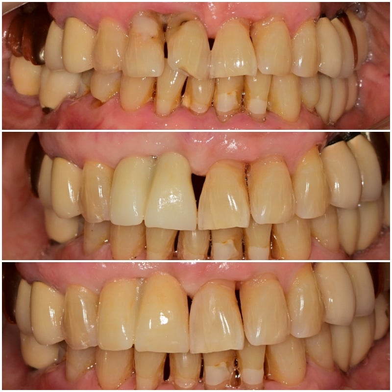 Yaksu-dong Dental Clinic: Treating Receding Gums Without Tooth Reduction 사진 10