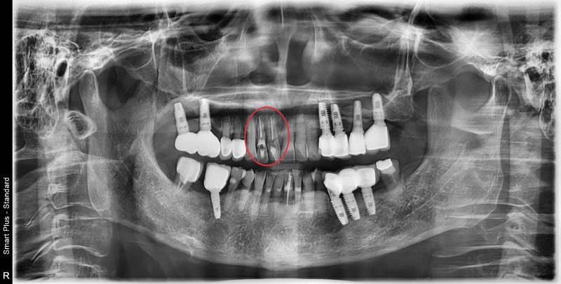 Yaksu-dong Dental Clinic: Treating Receding Gums Without Tooth Reduction 사진 3