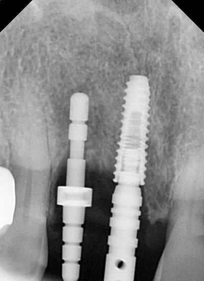 Yaksu-dong Dental Clinic: Treating Receding Gums Without Tooth Reduction 사진 4