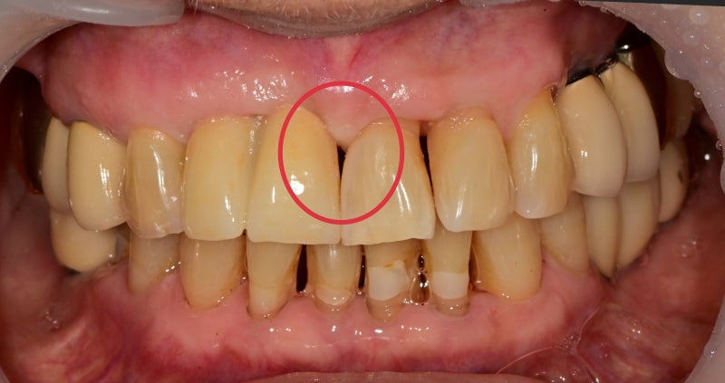 Yaksu-dong Dental Clinic: Treating Receding Gums Without Tooth Reduction 사진 8