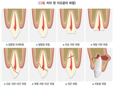 버티고개역 치과 앞니 외상에 따른 치료방법( 넘어져서 치아가 부러졌어요)
