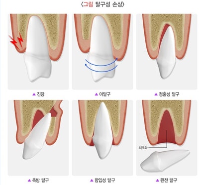 버티고개역 치과 앞니 외상에 따른 치료방법( 넘어져서 치아가 부러졌어요) 사진 2