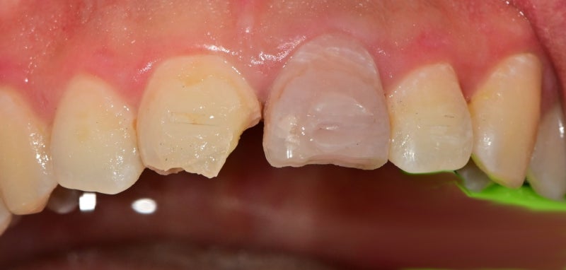 버티고개역 치과 앞니 외상에 따른 치료방법( 넘어져서 치아가 부러졌어요) 사진 8