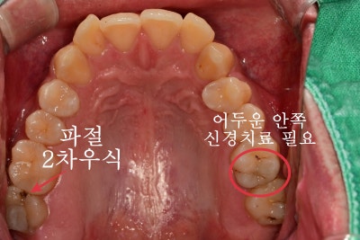 首尔中区牙科治疗：牙齿根管治疗后是否需要牙冠？ 사진 2