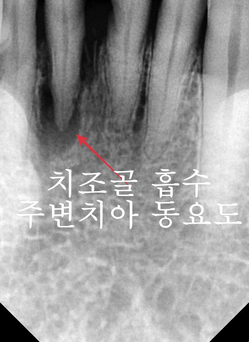 성동구 옥수동 치과 앞니 임플란트수술 즉시 임시치아 제작(구강스캐너를 이용한 수술절차) 사진 3
