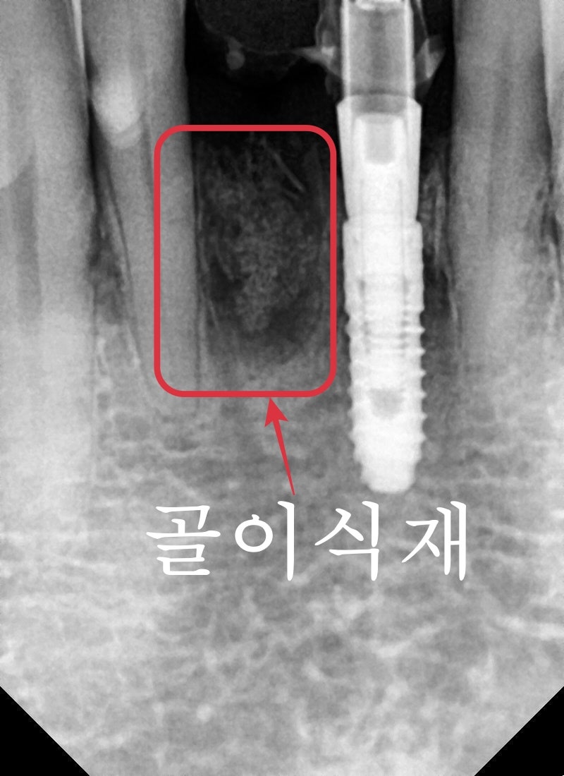 성동구 옥수동 치과 앞니 임플란트수술 즉시 임시치아 제작(구강스캐너를 이용한 수술절차) 사진 7
