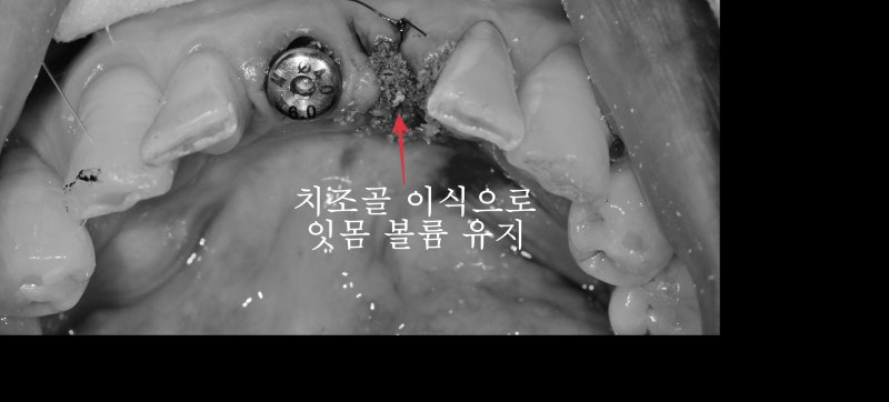 성동구 옥수동 치과 앞니 임플란트수술 즉시 임시치아 제작(구강스캐너를 이용한 수술절차) 사진 5
