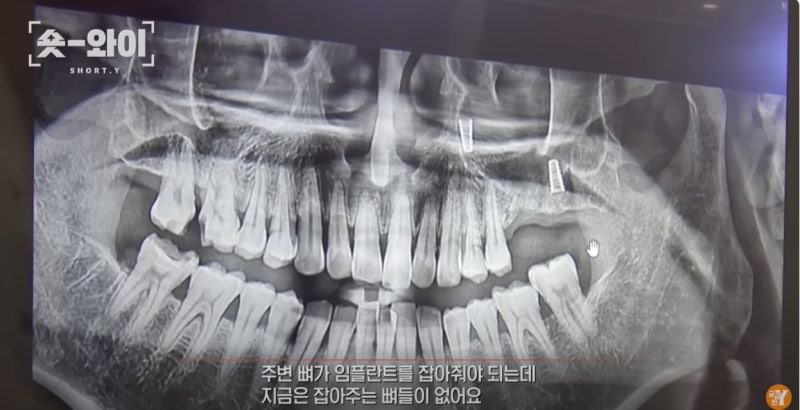중구 약수역 김태영 원장 SBS '궁금한 이야기 Y' 치과의사 자문 출연 사진 6