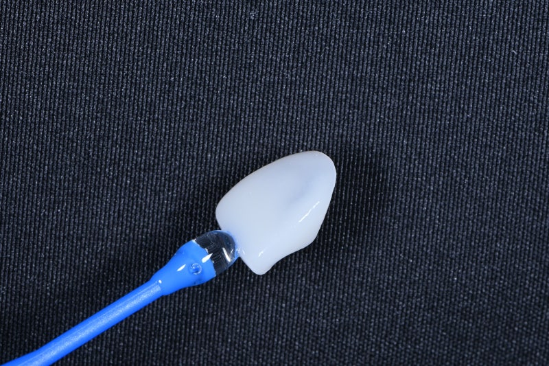 동대문 무삭제라미네이트 과거 교정한 치아가 웃을 때 안 보여 스트레스일 때 사진 6