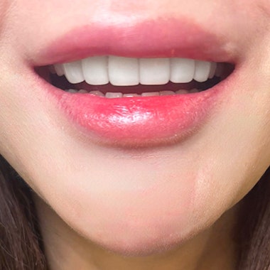 동대문 무삭제라미네이트 과거 교정한 치아가 웃을 때 안 보여 스트레스일 때 사진 9