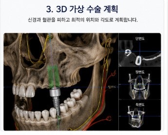약수역치과 디지털 장비를 이용한 효율적인 임플란트 수술 및 장점 사진 5