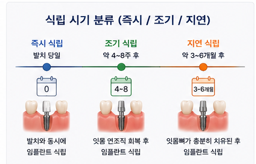 药水站牙科拔牙后种植牙的植入时机如何确定？ 사진 3