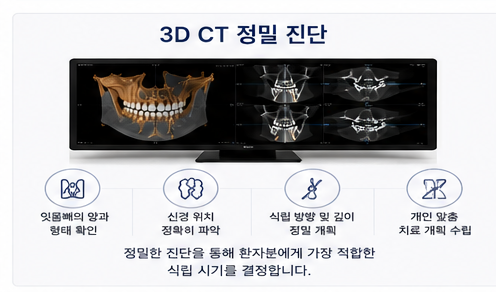 약수역 치과 발치후 임플란트 식립시기는 어떻게 정해질까요?