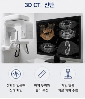약수역 임플란트, 뼈이식 없이 가능한 경우도 있을까요? 사진 4