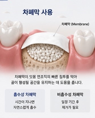 약수역 임플란트, 뼈이식 없이 가능한 경우도 있을까요? 사진 2