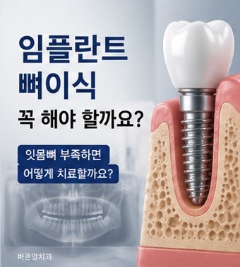 약수역 임플란트, 뼈이식 없이 가능한 경우도 있을까요?