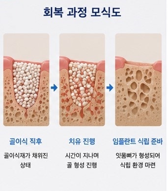 약수역 임플란트, 뼈이식 없이 가능한 경우도 있을까요?
