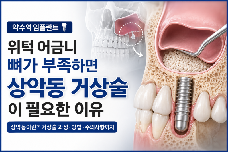 약수역 치과, 임플란트 상악동 거상술, 꼭 필요한 경우는? 사진 10