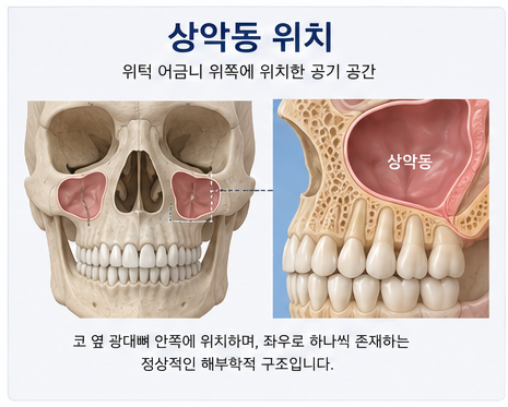 약수역 치과, 임플란트 상악동 거상술, 꼭 필요한 경우는?