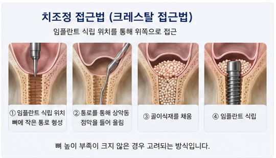 약수역 치과, 임플란트 상악동 거상술, 꼭 필요한 경우는?