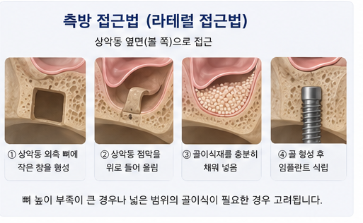 약수역 치과, 임플란트 상악동 거상술, 꼭 필요한 경우는? 사진 6