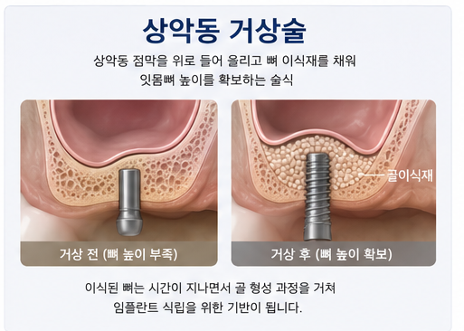 약수역 치과, 임플란트 상악동 거상술, 꼭 필요한 경우는? 사진 3