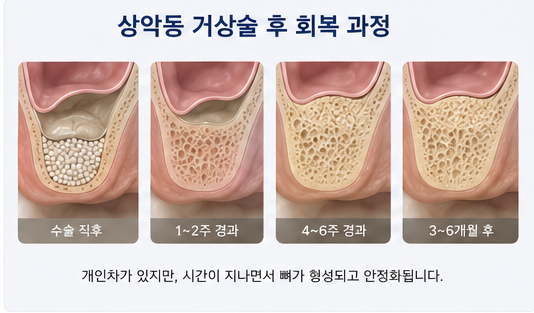 약수역 치과, 임플란트 상악동 거상술, 꼭 필요한 경우는? 사진 7