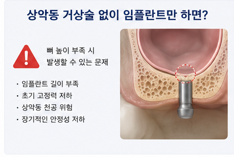 약수역 치과, 임플란트 상악동 거상술, 꼭 필요한 경우는? 사진 4