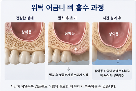약수역 치과, 임플란트 상악동 거상술, 꼭 필요한 경우는? 사진 2
