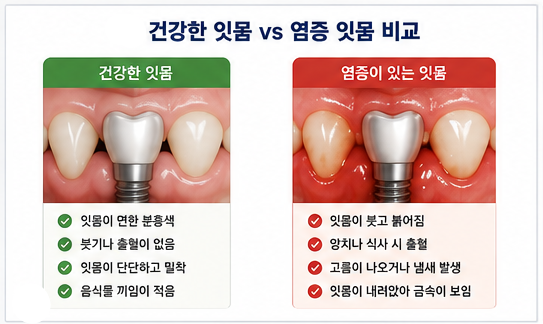 약수역 치과, 임플란트도 잇몸병이 생길 수 있을까요?