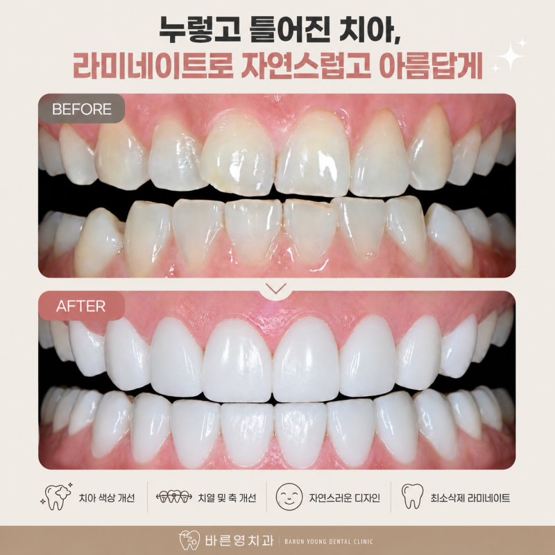 약수역 치과 라미네이트 vs 올세라믹, 어떤 치료가 더 좋을까요?